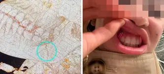 Москвичке случайно сломали челюсть во время удаления зуба мудрости.webp